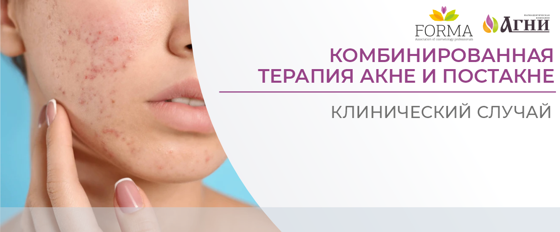 Комбинированная терапия акне и постакне: клинический случай