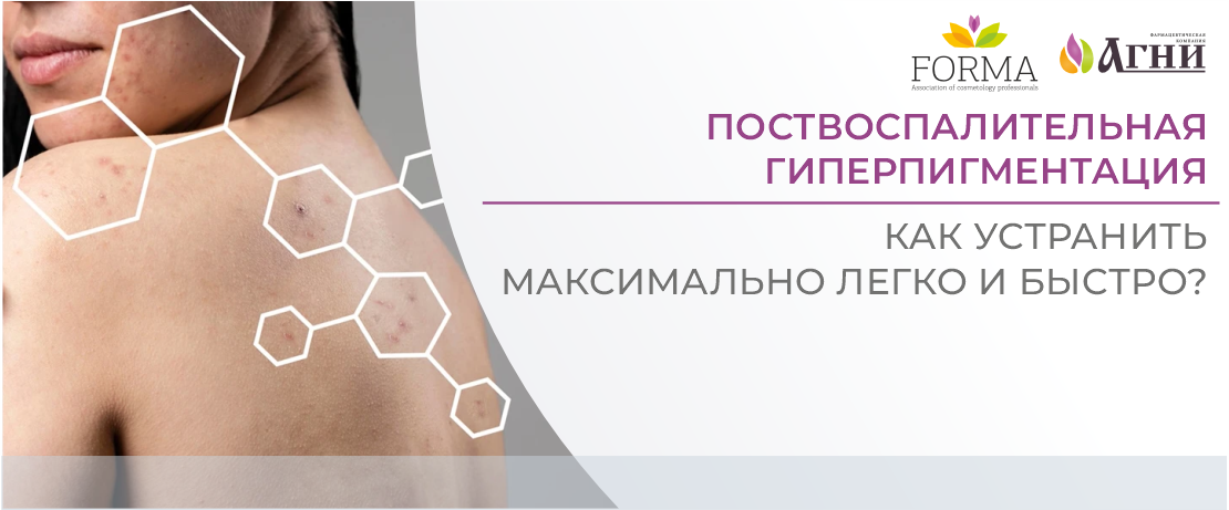 Поствоспалительная гиперпигментация: как устранить максимально легко и быстро?
