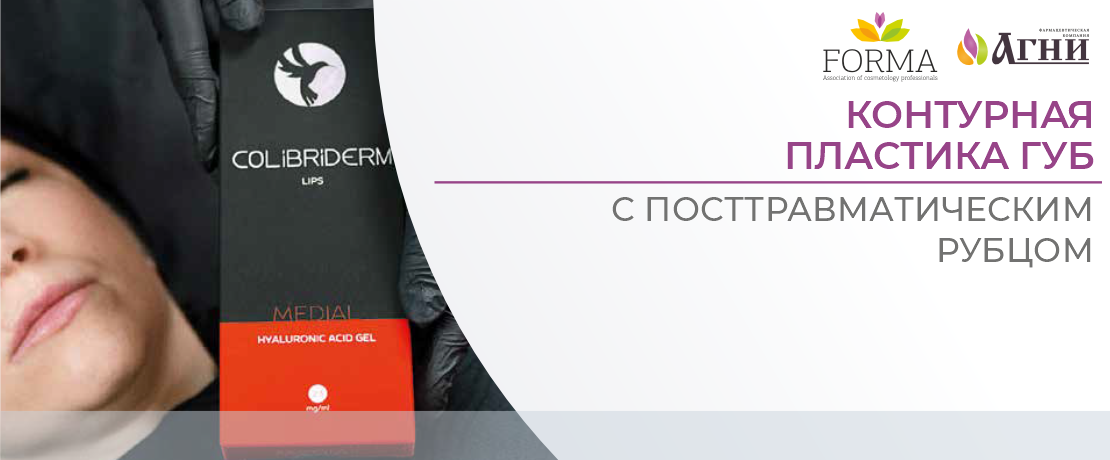 Контурная пластика губ с посттравматическим рубцом