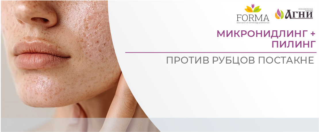 Микронидлинг + пилинг против рубцов постакне